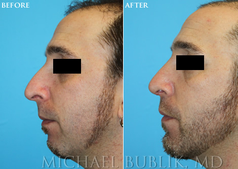 Male Chin Augmentation image left side view