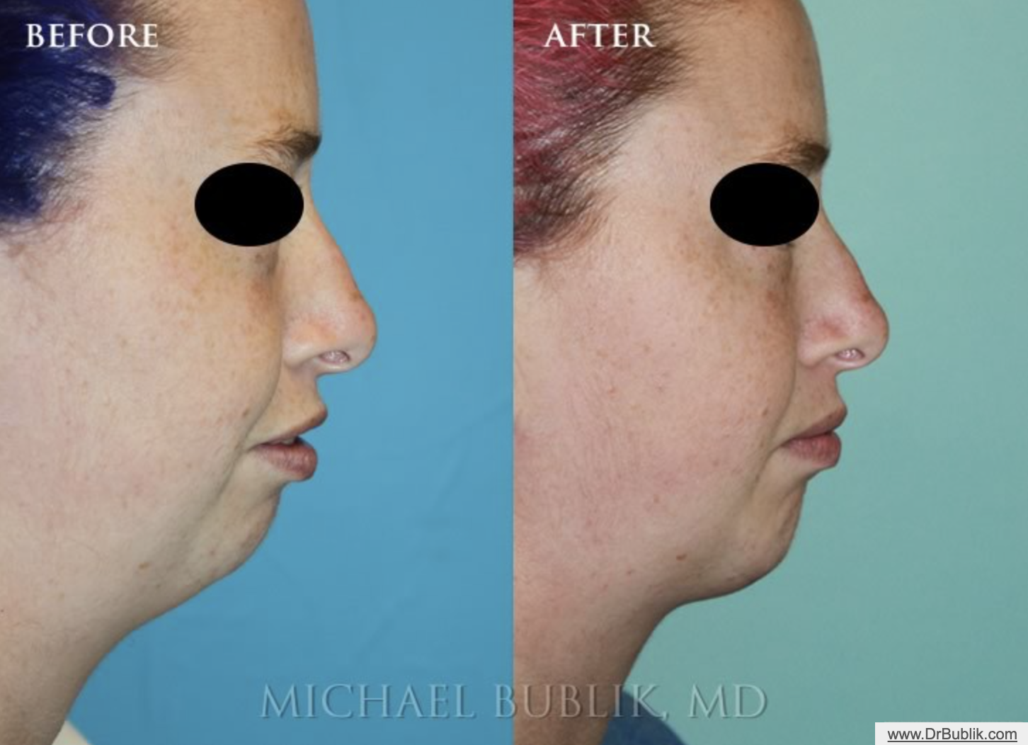 Chin Liposuction Female side view