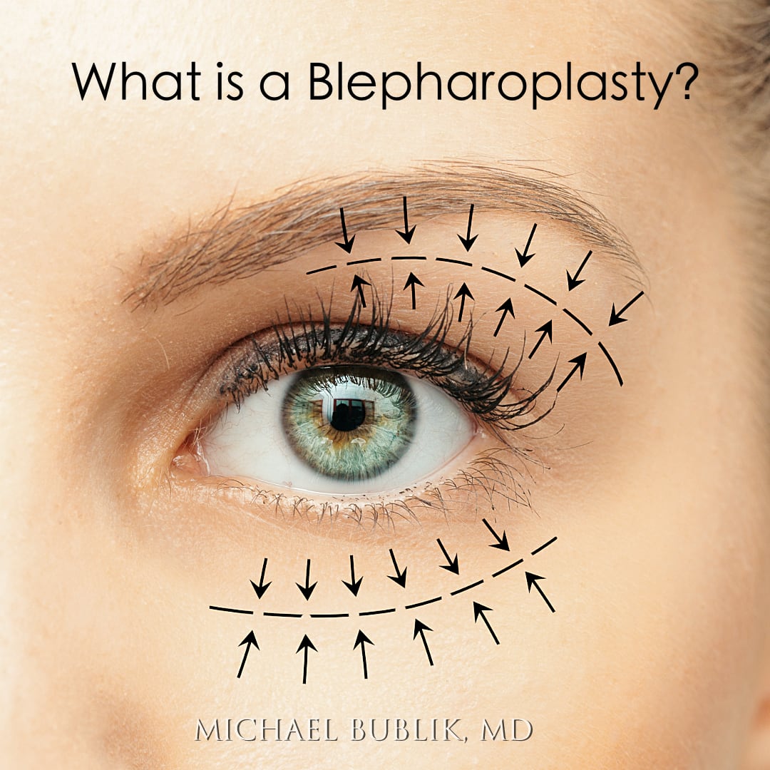 Blepharoplasty LA