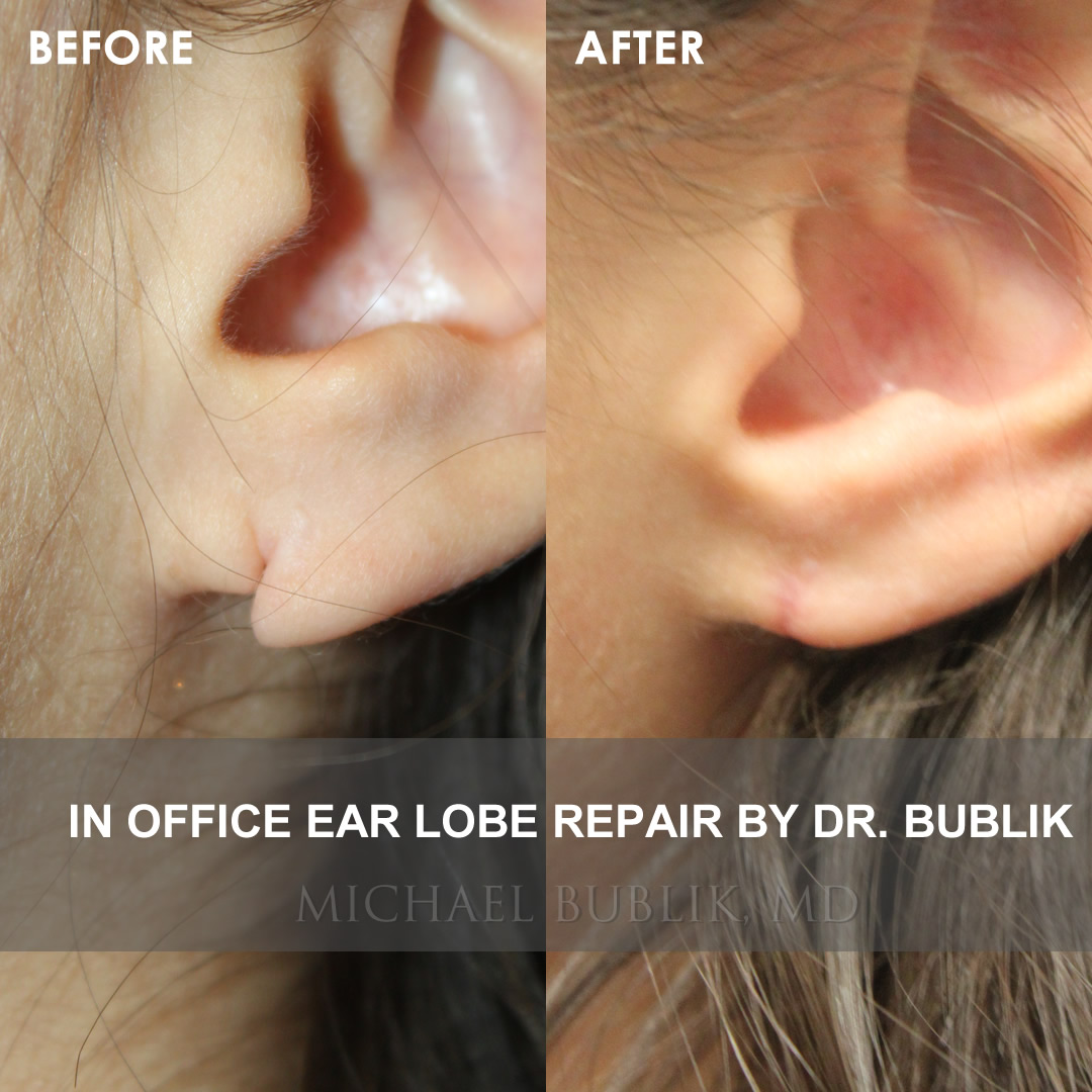 Ear Lobe Repair LA