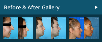 Before and After Plastic Surgery Photo Gallery