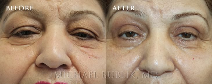 Before and After Blepharoplasty performed by Dr. Bublik