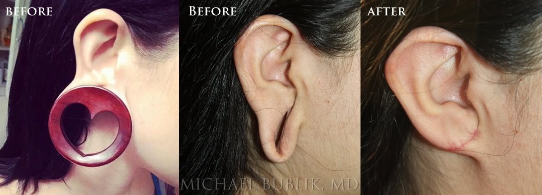 Ear Lob Repair by Dr. Michael Bublik