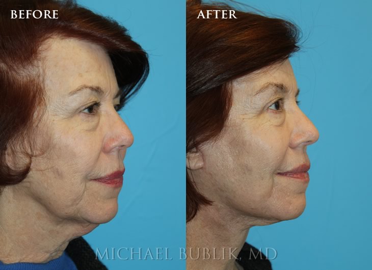 Facelift Before and after