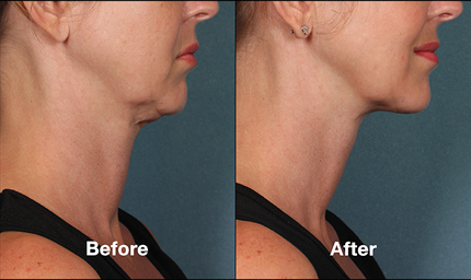Kybella Before and After Images