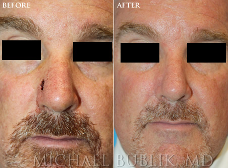Mohs Reconstruction before and after side nose