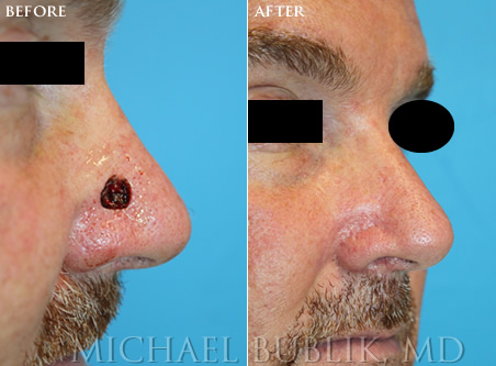 Mohs Reconstruction before and after side nose