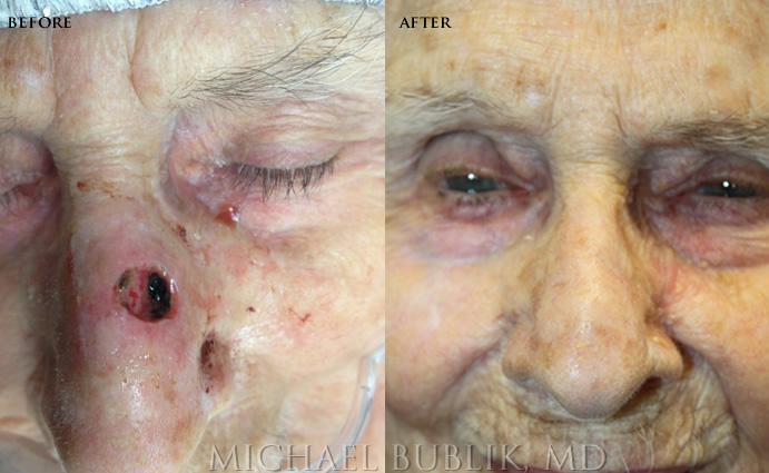 Mohs Reconstruction before and after nose