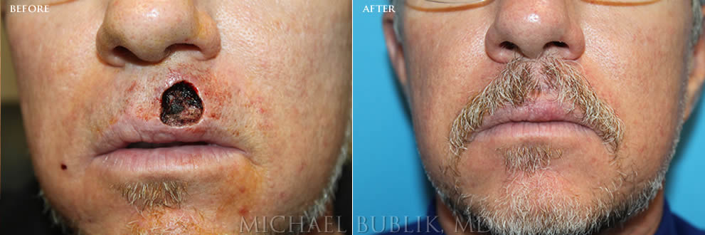 Mohs Reconstruction before and after Upper Lip