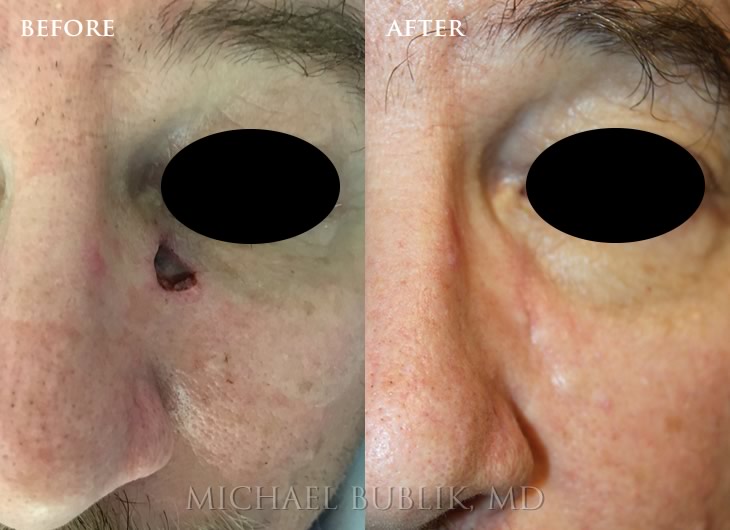 Mohs Reconstruction before and after eye