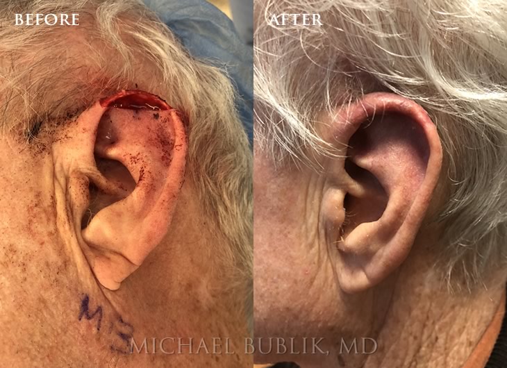 Mohs Reconstruction before and after ear