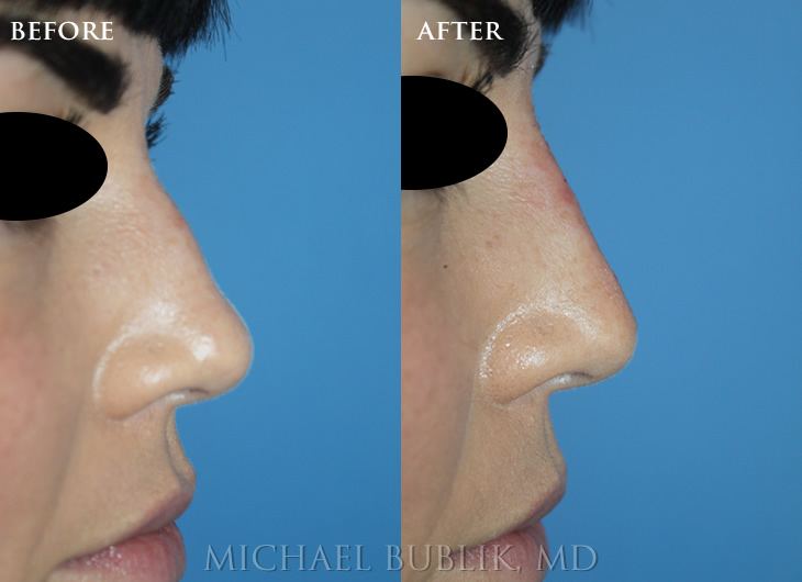 Non Surgical Nose Job with Restylane Filler