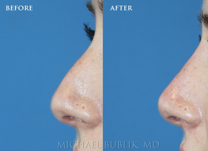 Nose Job using Fillers by Dr. Michael bublik