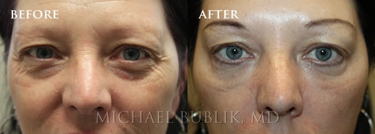 Under Eye Filler (Tear Trough) Before and After Photo