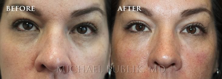 Under Eye Filler (Tear Trough) Before and After Photo