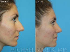 Clinical History: Healthy female with difficulty breathing through the nose, nasal hump, and wide nasal tip Procedures: Rhinoplasty with hump reduction (full osteotomies), and tip-plasty using dome unit sutures, septal cartilage grafts, and paradomal trim. Graft Types: Columellar strut, spreader graft.