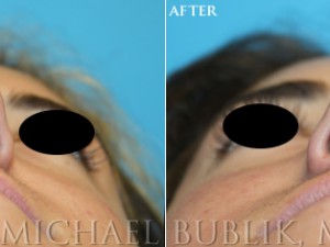 Healthy female with difficulty breathing through the nose, crooked nose, nasal hump. Procedures: Rhinoplasty with hump reduction (full osteotomies), and tip-plasty using dome unit sutures, septal cartilage grafts, and paradomal trim. Graft Types: Columellar strut, spreader grafts.