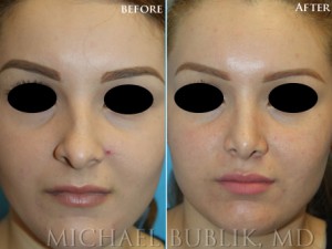 Healthy female with difficulty breathing through the nose, crooked nose, nasal hump.   Procedures: Rhinoplasty with hump reduction (full osteotomies), and tip-plasty using dome unit sutures, septal cartilage grafts, and paradomal trim. Graft Types: Columellar strut, spreader graft.