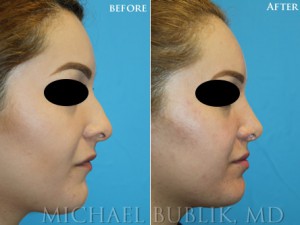 Healthy female with difficulty breathing through the nose, crooked nose, nasal hump.   Procedures: Rhinoplasty with hump reduction (full osteotomies), and tip-plasty using dome unit sutures, septal cartilage grafts, and paradomal trim. Graft Types: Columellar strut, spreader graft.