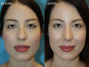 Clinical Summary: This young lady had a rhinoplasty ("nose reshaping').  She had a nasal bump, droopy and wide nasal tip, and was not able to breath well through her nose.   She underwent rhinoplasty, septoplasty, and turbinate reduction. You can see how she no longer has a nasal bump and her tip is no longer droopy or wide. She was very happy with her outcome and it is evident in her eyes.