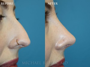 Clinical Summary: This young lady had a rhinoplasty ("nose reshaping').  She had a nasal bump, droopy and wide nasal tip, and was not able to breath well through her nose.   She underwent rhinoplasty, septoplasty, and turbinate reduction. You can see how she no longer has a nasal bump and her tip is no longer droopy or wide. She was very happy with her outcome and it is evident in her eyes.