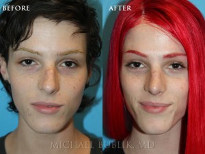 Clinical History:  This young lady had a rhinoplasty ("nose reshaping'). She had a nasal bump, crooked nose, droopy and wide nasal tip, and was not able to breath well through her nose. She underwent rhinoplasty, septoplasty, and turbinate reduction. You can see how she no longer has a nasal bump and her tip is no longer droopy or wide. She was very happy with her outcome and it is evident in her eyes.  In addition, on the lateral view you can see how the "morphe" images that are discussed in the preoperative visit approximate the final result.
