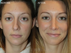 Clinical History: Young female patient underwent nose reshaping ("rhinoplasty") for a droopy tip, nasal bump and wide tip. As you can see the nasal tip has been elevated, bump reduced, the tip narrowed to give a more natural female appearing nasal profile. She was very happy with her result and quick and painless recovery.