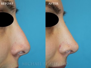Clinical History: This patient had nose reshaping (rhinoplasty) for a droopy tip and nasal bump. She was very happy with her results.