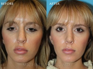 Clinical History: Young female patient underwent nose reshaping ("rhinoplasty") for a droopy tip, nasal bump and wide tip. As you can see the nasal tip has been elevated, bump reduced, the tip narrowed to give a more natural female appearing nasal profile. She was very happy with her result and quick and painless recovery. She also had a septoplasty and turbinate reduction for breathing issues. 