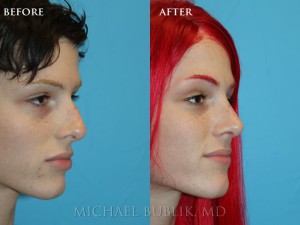 Clinical History:  This young lady had a rhinoplasty ("nose reshaping'). She had a nasal bump, crooked nose, droopy and wide nasal tip, and was not able to breath well through her nose. She underwent rhinoplasty, septoplasty, and turbinate reduction. You can see how she no longer has a nasal bump and her tip is no longer droopy or wide. She was very happy with her outcome and it is evident in her eyes.  In addition, on the lateral view you can see how the "morphe" images that are discussed in the preoperative visit approximate the final result.