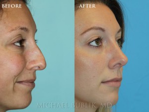 Clinical History: Young female patient underwent nose reshaping ("rhinoplasty") for a droopy tip, nasal bump and wide tip. As you can see the nasal tip has been elevated, bump reduced, the tip narrowed to give a more natural female appearing nasal profile. She was very happy with her result and quick and painless recovery.