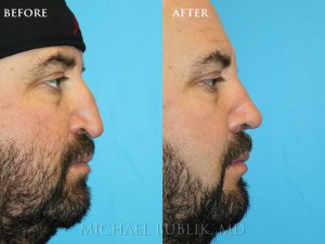 Clinical Summary: This gentleman had a septoplasty, turbinate reduction and rhinoplasty ("nose reshaping'). He had a very droopy tip that was obstructing his breathing and a nasal bump. He underwent rhinoplasty, septoplasty, and turbinate reduction. You can see how he no longer has a nasal bump and his tip position. She was very happy with her outcome and it is evident in her eyes.