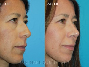 Clinical History:  Young female patient underwent nose reshaping ("rhinoplasty") for a droopy tip, nasal bump and wide tip.  As you can see the nasal tip has been elevated, bump reduced, the tip narrowed to give a more natural female appearing nasal profile.   She was very happy with her result and quick and painless recovery. 