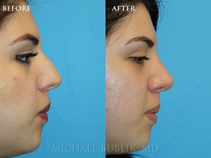 Clinical History: Young female patient with very thick skin underwent nose reshaping ("rhinoplasty") for a droopy tip, nasal bump and wide tip. As you can see the nasal tip has been elevated, bump reduced, the tip narrowed to give a more natural female appearing nasal profile. She was very happy with her result and quick and painless recovery and the result was achieved even with a thick skin nose.