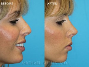 Clinical History: Young female patient underwent nose reshaping ("rhinoplasty") for a droopy tip, nasal bump and wide tip. As you can see the nasal tip has been elevated, bump reduced, the tip narrowed to give a more natural female appearing nasal profile. She was very happy with her result and quick and painless recovery. She also had a septoplasty and turbinate reduction for breathing issues. 