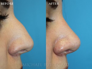 Clinical History: Young female patient with very thick skin underwent nose reshaping ("rhinoplasty") for a droopy tip, nasal bump and wide tip. As you can see the nasal tip has been elevated, bump reduced, the tip narrowed to give a more natural female appearing nasal profile. She was very happy with her result and quick and painless recovery and the result was achieved even with a thick skin nose.
