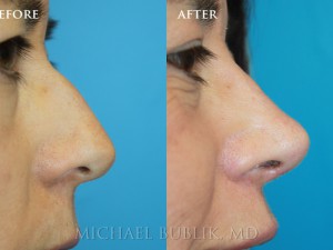 Clinical History:  Young female patient underwent nose reshaping ("rhinoplasty") for a droopy tip, nasal bump and wide tip.  As you can see the nasal tip has been elevated, bump reduced, the tip narrowed to give a more natural female appearing nasal profile.   She was very happy with her result and quick and painless recovery. 