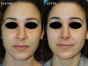 This young female underwent a nose reshaping (rhinoplasty).  She had a crooked nose with a dorsal hump and droopy tip.  The result is both natural and elegant.  She no longer has a long nose that is droopy, crooked and the nasal profile is feminine and natural appearing. 