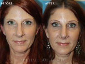 Clinical history:  This lady had a long standing history of nasal breathing difficulty and concerns about her nasal bump and slightly over projected nasal tip.  She underwent rhinoplasty ("nose job"), septoplasty, and turbinate reduction. She was very happy with the result. 
