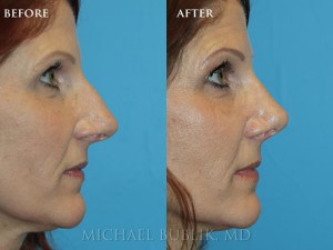 Clinical history:  This lady had a long standing history of nasal breathing difficulty and concerns about her nasal bump and slightly over projected nasal tip.  She underwent rhinoplasty ("nose job"), septoplasty, and turbinate reduction. She was very happy with the result.