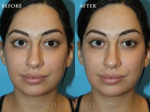 Clinical History:  This patient underwent a rhinoplasty ("nose job") and chin implant.  She complained of large nasal bump, droopy tip, and small chin.  She had quick healing and recovery.  You can notice on the postop pictures that the nasal bump was removed on the bridge of the nose, the tip was raised, then chin was given more projection, and her overall result was a more feminine and natural appearing nose. 