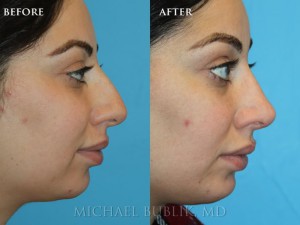 Clinical History:  This patient underwent a rhinoplasty ("nose job") and chin implant.  She complained of large nasal bump, droopy tip, and small chin.  She had quick healing and recovery.  You can notice on the postop pictures that the nasal bump was removed on the bridge of the nose, the tip was raised, then chin was given more projection, and her overall result was a more feminine and natural appearing nose. 