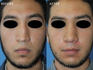 Case study: This patient underwent rhinoplasty ("nose job") to correct a crooked nose and dorsal hump and droopy tip. You can see that the nose is no longer crooked and he has a natural and straight appearing nasal profile.