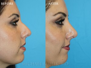 Clinical history: Young female patient underwent nose reshaping ("rhinoplasty") for a droopy tip, nasal bump, wide tip and crooked nose on frontal view. As you can see the nasal tip has been elevated, bump reduced, the tip narrowed to give a more natural female appearing nasal profile. In addition, you can appreciate that the nose is now straight on the front view.  She was very happy with her result and quick and painless recovery.