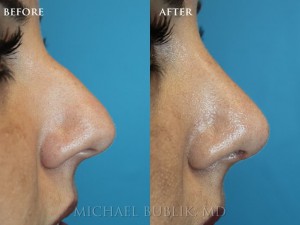 Clinical history: Young female patient underwent nose reshaping ("rhinoplasty") for a droopy tip, nasal bump, wide tip and crooked nose on frontal view. As you can see the nasal tip has been elevated, bump reduced, the tip narrowed to give a more natural female appearing nasal profile. In addition, you can appreciate that the nose is now straight on the front view.  She was very happy with her result and quick and painless recovery.
