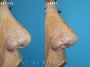 This patient had a revision rhinoplasty (nose job).  She had a "polly-beak deformity" and was unhappy with the bulbosity of the nasal tip.  You can see (arrow) the improvement and more feminine appearing nasal profile.