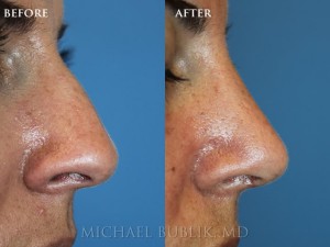 Clinical History: Young lady under cosmetic and functional rhinoplasty ("nose job"). You can see that droopy and wide nasal tip has been corrected and the bridge bump has been smoothed out to give a very beautiful, natural and feminine appearing nasal profile.