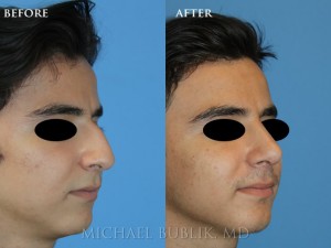 Clinical History: This teenager had a cosmetic and functional rhinoplasty to correct a severely large dorsal hump (bridge height). He was able to return to school within a week and had much greater self esteem. Him and his parents were extremely happy with the natural appearing result.