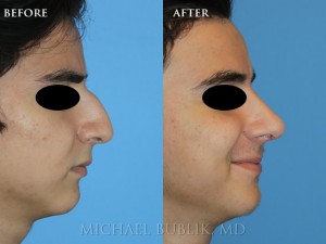 Clinical History: This teenager had a cosmetic and functional rhinoplasty to correct a severely large dorsal hump (bridge height). He was able to return to school within a week and had much greater self esteem. Him and his parents were extremely happy with the natural appearing result.