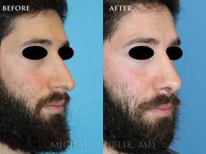 Clinical history: Male rhinoplasty (nosejob).  This patient had a crooked nose, droopy tip and nasal bridge bump as well as severe breathing difficulty. He was very happy with the natural resul which is especially important for male patients.